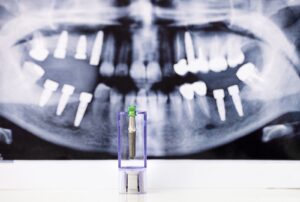 Scopri di più sull'articolo Che cos’è l’implantologia dentale e come funziona?