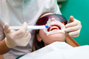 Scopri di più sull'articolo Sbiancamento dentale: i prodotti più efficaci sul mercato e come utilizzarli correttamente