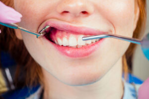 Scopri di più sull'articolo Sbiancamento denti e sensibilità: come gestire il disagio.
