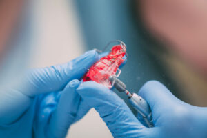 Scopri di più sull'articolo Quanto costa il trattamento con gli apparecchi dentali?