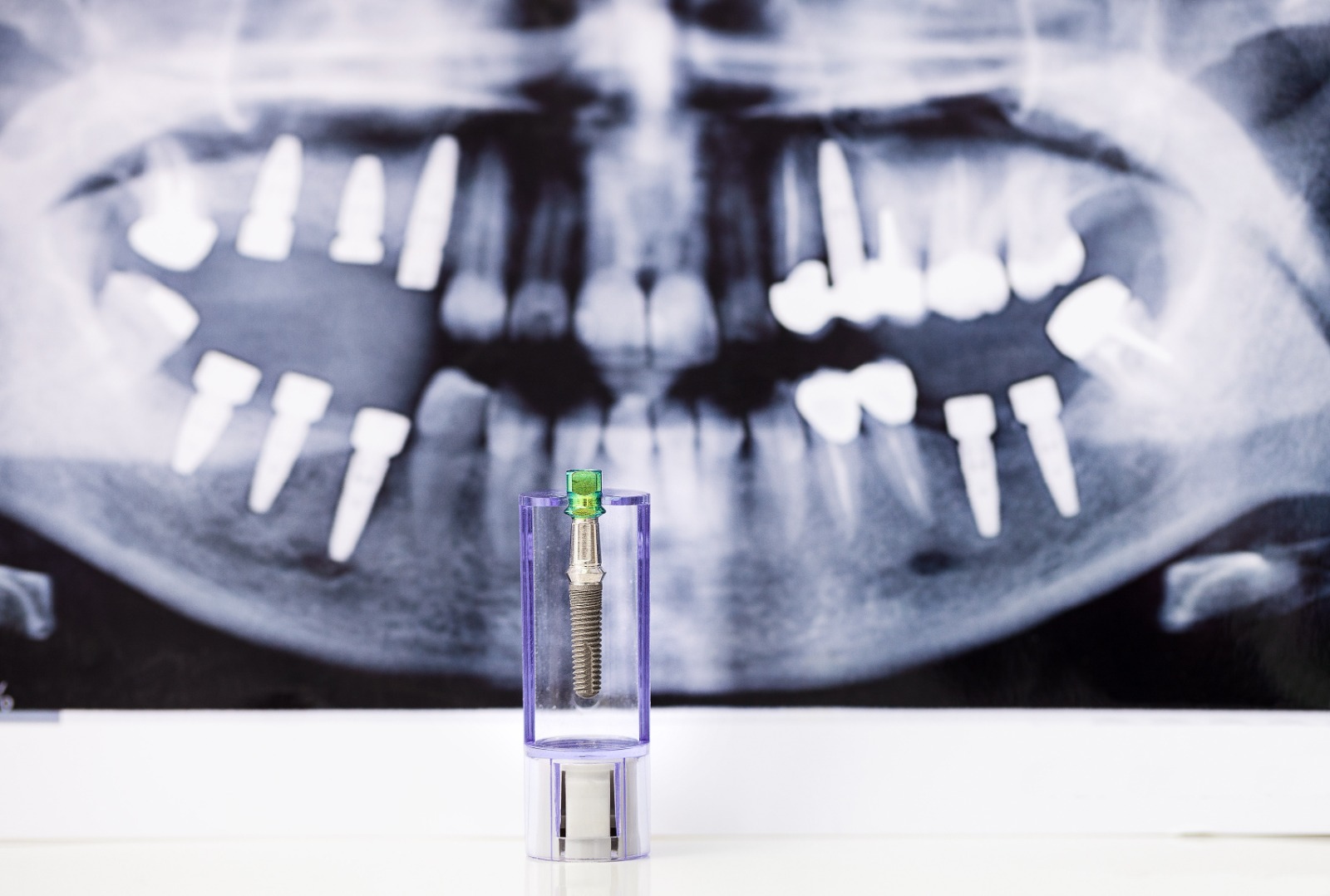 Scopri di più sull'articolo Qual è il processo di guarigione dopo l’installazione di un impianto dentale?